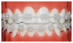 Ceramic Braces