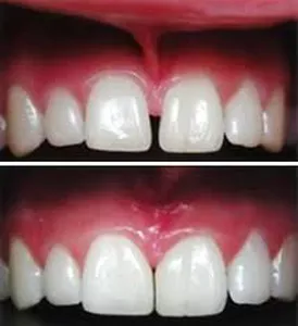 Frenectomy