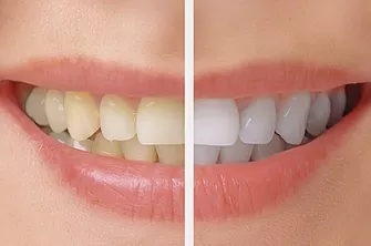 Tooth Whitening