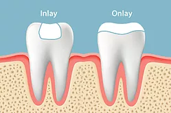 Inlays and Onlays